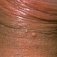 molluscum contagiosum on penis