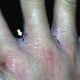 scabies on fingers