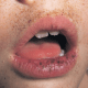 Peutz-Jeghers Syndrome