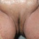 Tinea Cruris