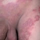 Tinea Cruris