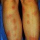 erythema nodosum