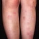 erythema nodosum