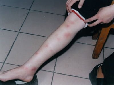 erythema nodosum