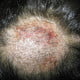 Tinea Capitis