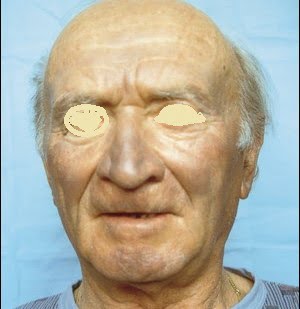 amiodarone induced pigmentation