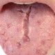 Fissured Cracked Tongue