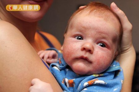 heat rash in babies