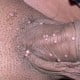 Molluscum Contagiosum on Penis