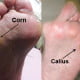 corn and callus