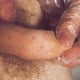 Molluscum Contagiosum on Penis