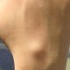 ganglion