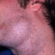 lymphoma