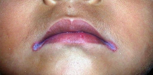 Rash in Corner of Mouth